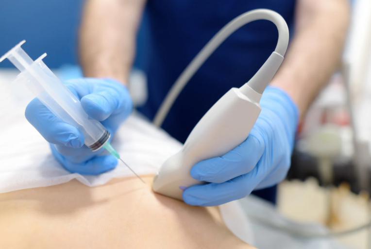 punção em nódulo de mama