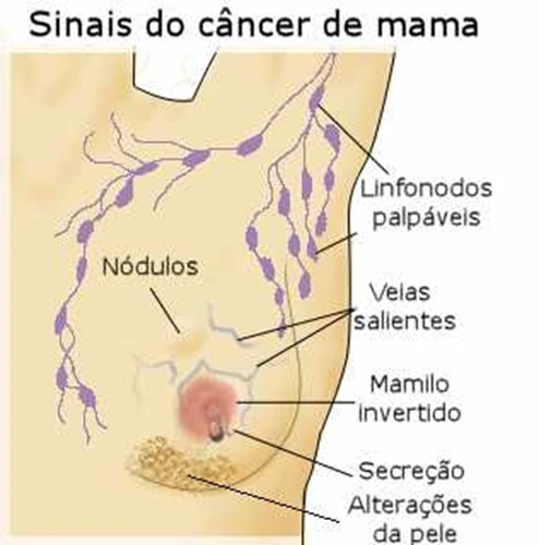 Sinais de alerta de nódulo de mama maligno